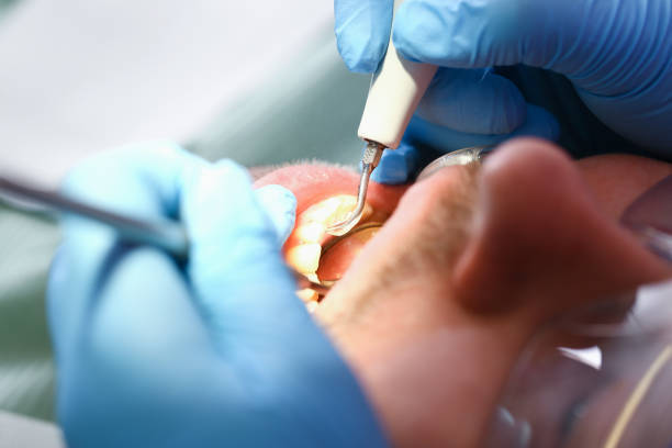Best Emergency Wisdom Teeth Removal in Linton Hall, VA